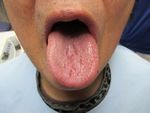 Using PF-MOUTH GELTM for Sore or Painful Tongue Improved Symptoms and Stabilized Dryness and Trapping of Food: A Case Report