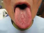 Using PF-MOUTH GELTM for Sore or Painful Tongue Improved Symptoms and Stabilized Dryness and Trapping of Food: A Case Report