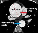 Successful Surgical Treatment of Coronary Aneurysm, Ascending Aortic Aneurysm, and Bicuspid Aorta for a Kawasaki Disease Patient - bjcvs