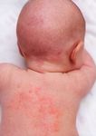 KIDS HEALTH when a little one IS SICK - What to do - Asthma Australia