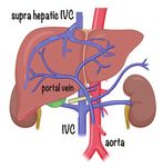Sleeve Gastrectomy Suppresses Hepatic Glucose Production and Increases Hepatic Insulin Clearance Independent of Weight Loss