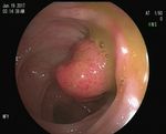 Case Report Spontaneous expulsion of a giant colonic lipoma: a case report and literature review