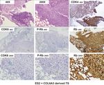 Original Article Collagen type VI regulates the CDK4/6-p-Rb signaling pathway and promotes ovarian cancer invasiveness, stemness, and metastasis