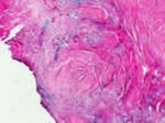 Endoscopic laser en bloc removal of bladder tumor. Surgical radicality and improvement of the pathological diagnostic accuracy