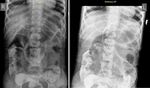 Management of Biloma due to Biliary Tract Injury after Laparoscopic Cholecystectomy in a patient with Atypical Anatomy: A Case Report
