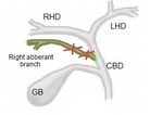 Management of Biloma due to Biliary Tract Injury after Laparoscopic Cholecystectomy in a patient with Atypical Anatomy: A Case Report