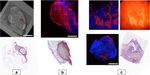 Endogenous fluorescence of hemosiderin in endometriosis to improve clinical detection