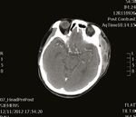 Dental abscess: A potential cause of death and morbidity - RACGP