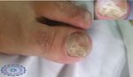 Nail Disorders in Patients with Chronic Renal Failure - ClinMed ...