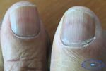 Nail Disorders in Patients with Chronic Renal Failure - ClinMed ...