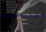 Optimal Implantation Site of Orthodontic Micro-Screws in the Mandibular Anterior Region Based on CBCT