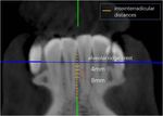 Optimal Implantation Site of Orthodontic Micro-Screws in the Mandibular Anterior Region Based on CBCT