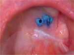 Mouth cancer: presentation, detection and referral in primary dental care - Exodontia.Info