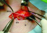Operative management of "hockey groin syndrome": 12 years of experience in National Hockey League players