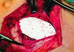 Operative management of "hockey groin syndrome": 12 years of experience in National Hockey League players
