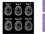 Case Report: End-Stage Recurrent Glioblastoma Treated With a New Noninvasive Non-Contact Oncomagnetic Device - Frontiers