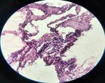 Cystic lymphangioma of breast and axillary region in an adult: a rare presentation