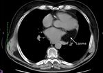 Unusual Location of a Posterior Lipoma Originating From the Left Atrial Roof: Case Report and Review of the Literature
