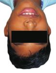 Dynamic smile reanimation in facial nerve palsy - Journal of ...