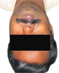 Dynamic smile reanimation in facial nerve palsy - Journal of ...