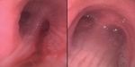 THE ROLE OF BRONCHOSCOPY IN PATIENTS WITH SARS-COV-2 PNEUMONIA