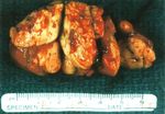 Metastatic Renal Cell Carcinoma to the Thyroid Gland