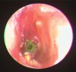 Case Report Middle Ear Ceruminous Gland Adenoma Obstructing the Eustachian Tube Orifice