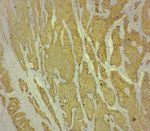 Unusual Presentation of Neuroendocrine Tumor with Multiple Endocrine Neoplasia 1 Syndrome: A Rare Case Report