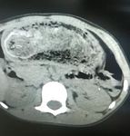 Trichobezoar: a rare clinical rendezvous with twin sisters