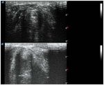 ULTRASONOGRAPHY OF THE LARYNX: NOVEL USE DURING THE SARS COV 2 PANDEMIC (REVIEW)