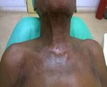 Cervico-Facial Necrotizing Fasciitis: A Ten-Year Clinical Evaluation of 80 Cases in Enugu, Eastern Nigeria - Remedy Publications