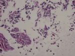 Kaposi Sarcoma-Like Lesions Caused by Candida guilliermondii Infection in a Kidney Transplant Patient
