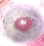 TEMPORAL SUBLUXATION OF A SCLERAL-FIXATED IOL