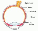 I-125 Plaque Brachytherapy for Choroidal Melanoma