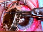 I-125 Plaque Brachytherapy for Choroidal Melanoma