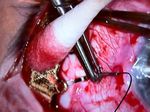 I-125 Plaque Brachytherapy for Choroidal Melanoma