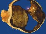 I-125 Plaque Brachytherapy for Choroidal Melanoma