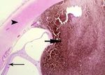 I-125 Plaque Brachytherapy for Choroidal Melanoma