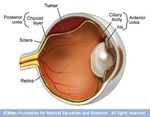 I-125 Plaque Brachytherapy for Choroidal Melanoma