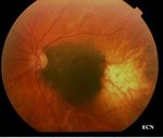 I-125 Plaque Brachytherapy for Choroidal Melanoma