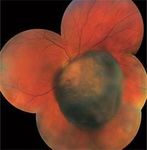 I-125 Plaque Brachytherapy for Choroidal Melanoma