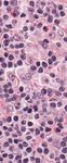 Teaching Cases in Hematology: A Virtual Slide Atlas - Jason C. Ford, MD, FRCP(C) Sophia Wong 2009 - Pathology and Laboratory ...