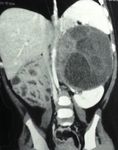 Primary Retroperitoneal Teratoma with Predominant Neurogenic Elements Masquerading as Adrenal Tumor