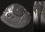Case Report Acute Complete Foot Drop Caused by Intraneural Ganglion Cyst without a Prior Traumatic Event