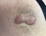 Intralesional Cryotherapy Versus Intralesional Corticosteroid and 5-Fluorouracil in the Treatment of Hypertrophic Scars and Keloids: A Clinical ...