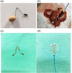 Bladder-embedded ectopic intrauterine device with calculus