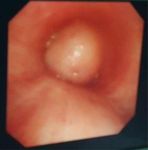 Multiple endo bronchial lipoma: a rare case report - BMC ...