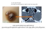 Surgical and Medical Management of Mycotoxin Neurotoxicity and Neuropsychological Symptoms via Endoscopic Sinusotomies and Cyclone Antifungal ...