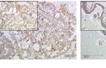 G Protein-Coupled Estrogen Receptor Correlates With Dkk2 Expression and Has Prognostic Impact in Ovarian Cancer Patients - Frontiers