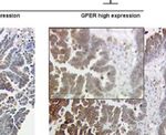 G Protein-Coupled Estrogen Receptor Correlates With Dkk2 Expression and Has Prognostic Impact in Ovarian Cancer Patients - Frontiers